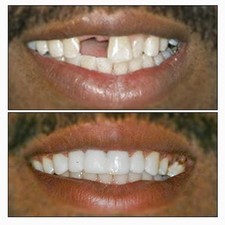 Makeup Kit In Care Ebay Temporary Tooth Repair Or Replace Kit Diy Makes 25 30 Teeth No Adhesive Needed